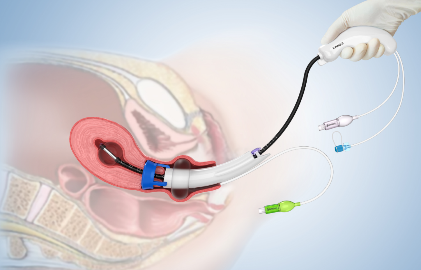 Kangji Disposable Uterine Manipulator and Vaginal Delinetaors-image